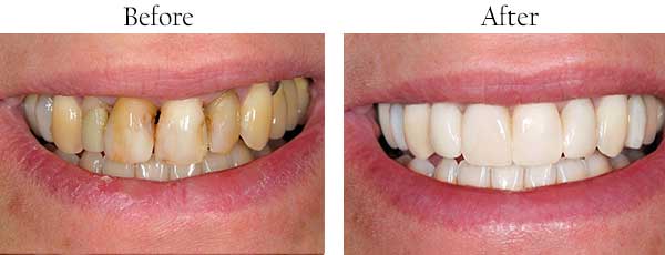 Ellicott City Before and After Teeth Whitening