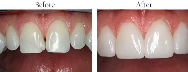 Ellicott City Before and After Dental Implants