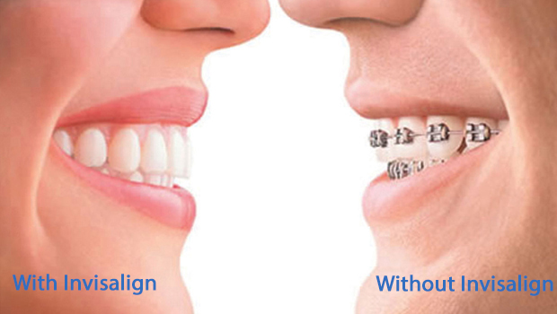 Invisalign in Ellicott City