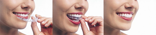 Ellicott City Invisalign