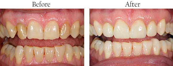 Ellicott City Before and After Dental Implants