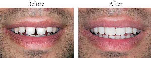 Ellicott City Before and After Dental Crowns