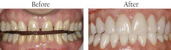 Ellicott City Before and After Teeth Whitening